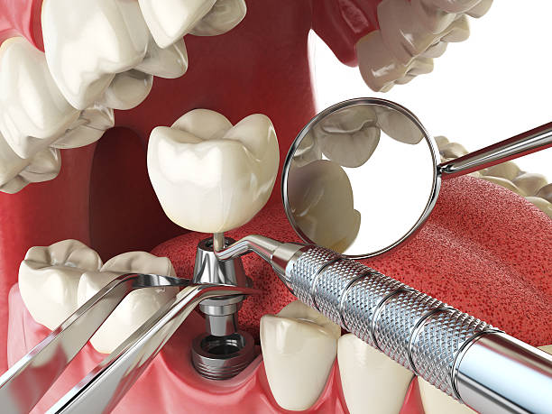 Best Emergency Tooth Extraction in Lone Pine, CA